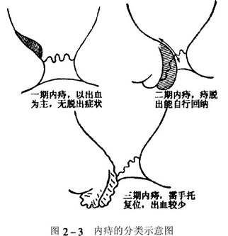 内痔的分类示意图