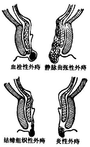 外痔