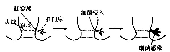 肛周脓肿的发病过程