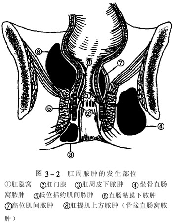 肛周脓肿症状特点