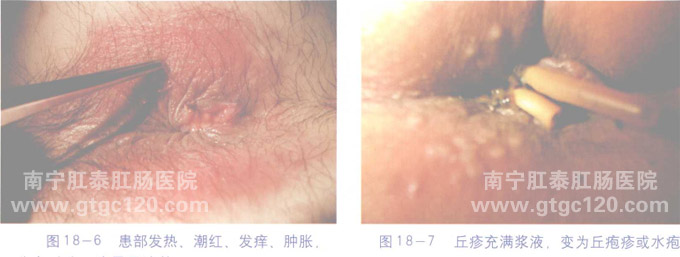 肛门湿疹症状图片