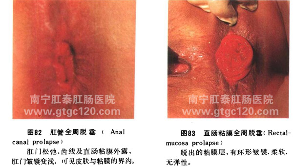 直肠粘膜全周脱垂的症状图片