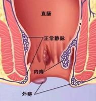 外痔疮症状的图片