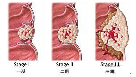 直肠恶变恶化示意图