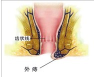 外痔示意图