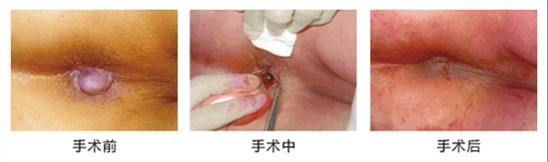 血栓性外痔剥离摘除术过程