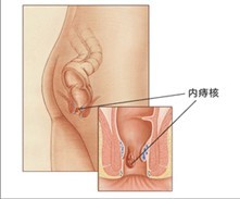 内痔示意图