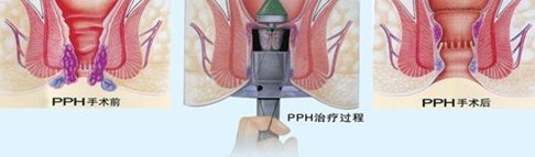 PPH手术过程示意图