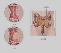 结肠恶变示意图