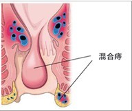 混合痔示意图