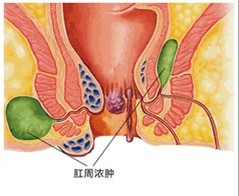 肛周脓肿示意图