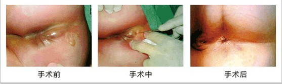 肛周脓肿切开引流手术过程