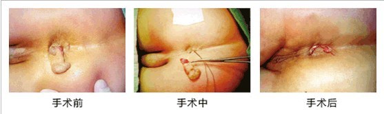 肛乳头瘤切除结扎术过程图解