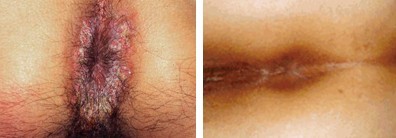 肛门疣病治疗前后对比图