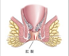 肛裂示意图