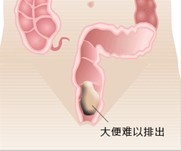 肠刺激不足导致排便困难