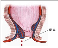 便血示意图