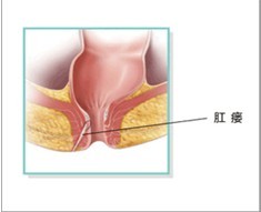 肛瘘示意图