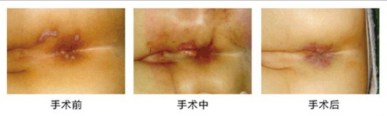 医博HCPT微创术治肛瘘创口小、恢复快、术后伤口平整