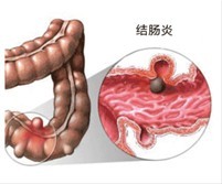 结肠炎致腹泻示意图