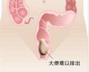 肠刺激不足导致排便困难