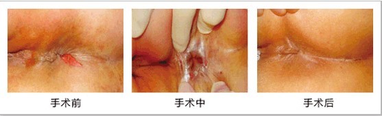 HCPT微创术治肛裂过程