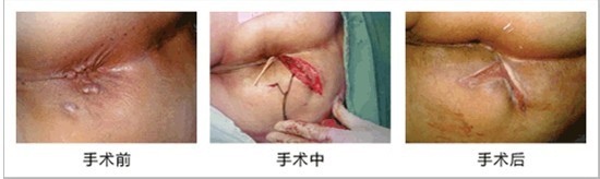 传统手术治肛瘘创口大、恢复慢、术后伤口不平整