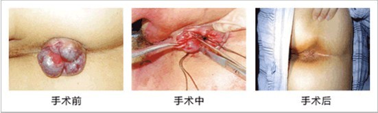 环状混合痔外切内扎手术过程