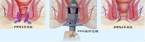 PPH手术过程示意图