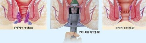 PPH手术过程示意图