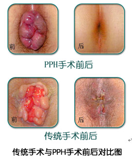 传统手术与医博PPH手术前后对比图