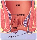 外痔