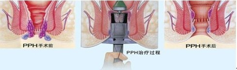 PPH手术过程示意图