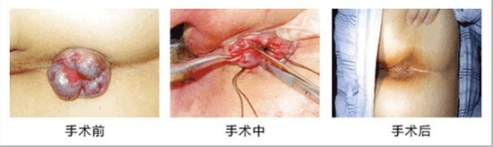 环状混合痔外切内扎手术过程