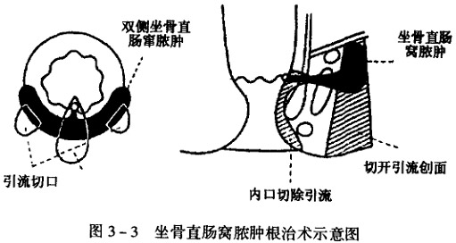 坐骨直肠窝脓肿根治术示意图