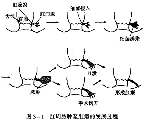 肛周脓肿至肛瘘的发展过程