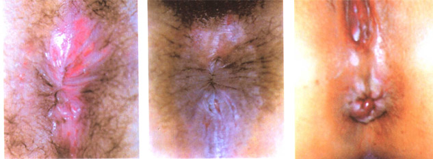 肛门瘙痒症状与图片的结合