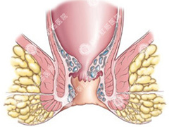痔疮