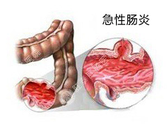 急性肠炎