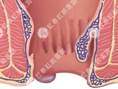 外痔疮