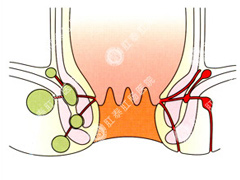 肛瘘
