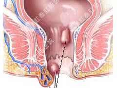 混合痔