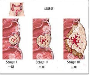 结肠炎