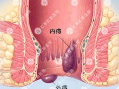 混合痔