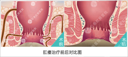 痔疮手术