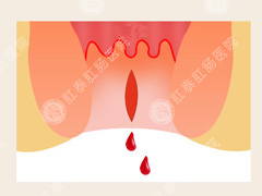 一直拉血是怎么回事?