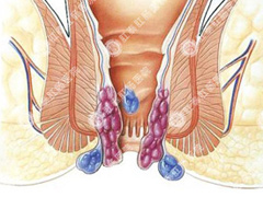 痔疮