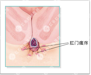 肛门瘙痒