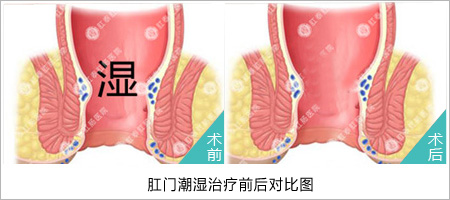 肛门潮湿