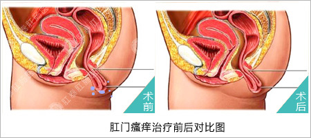 肛门瘙痒